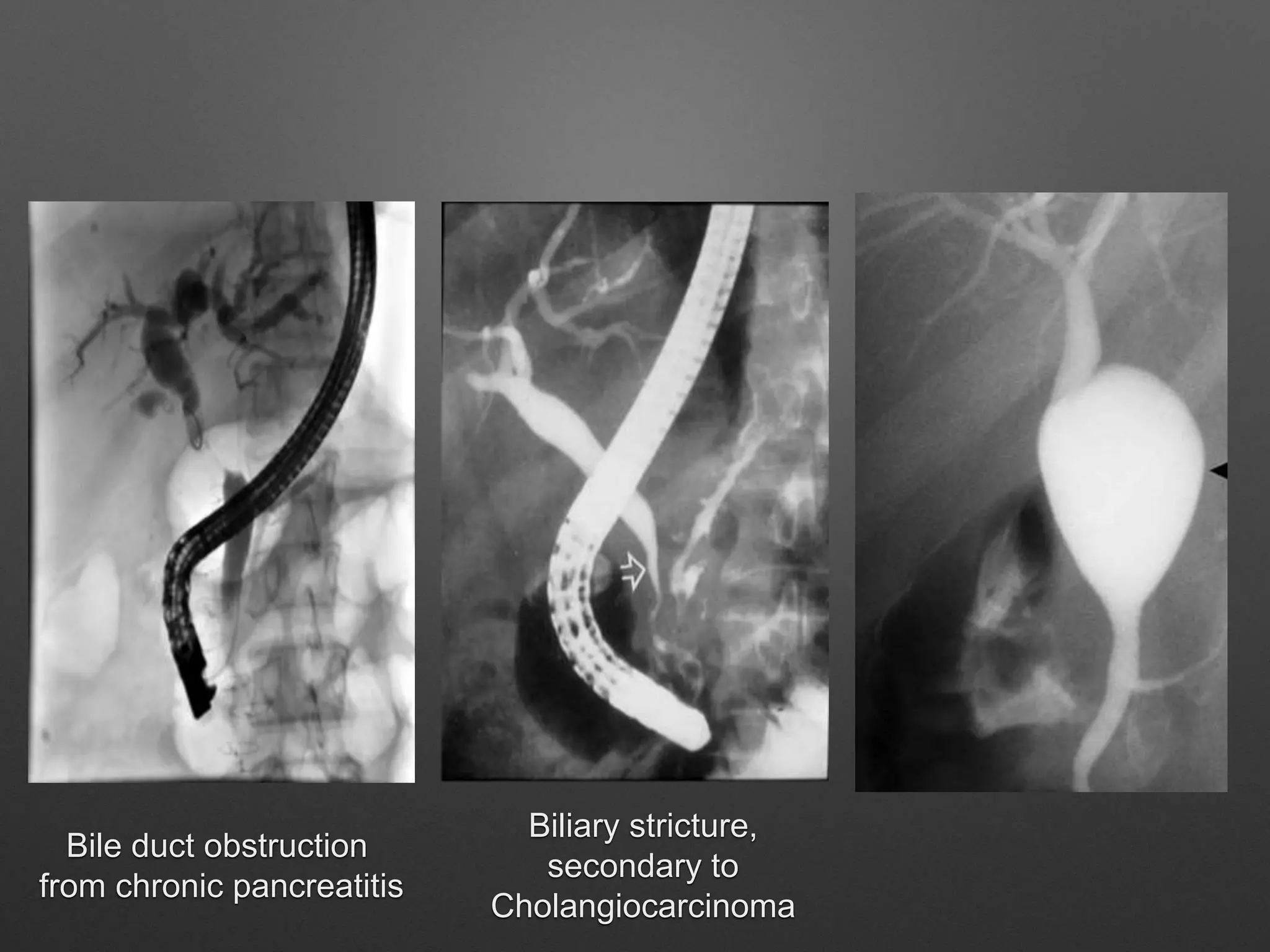 Bile duct obstruction
from chronic pancreatitis
Biliary stricture,
secondary to
Cholangiocarcinoma
 