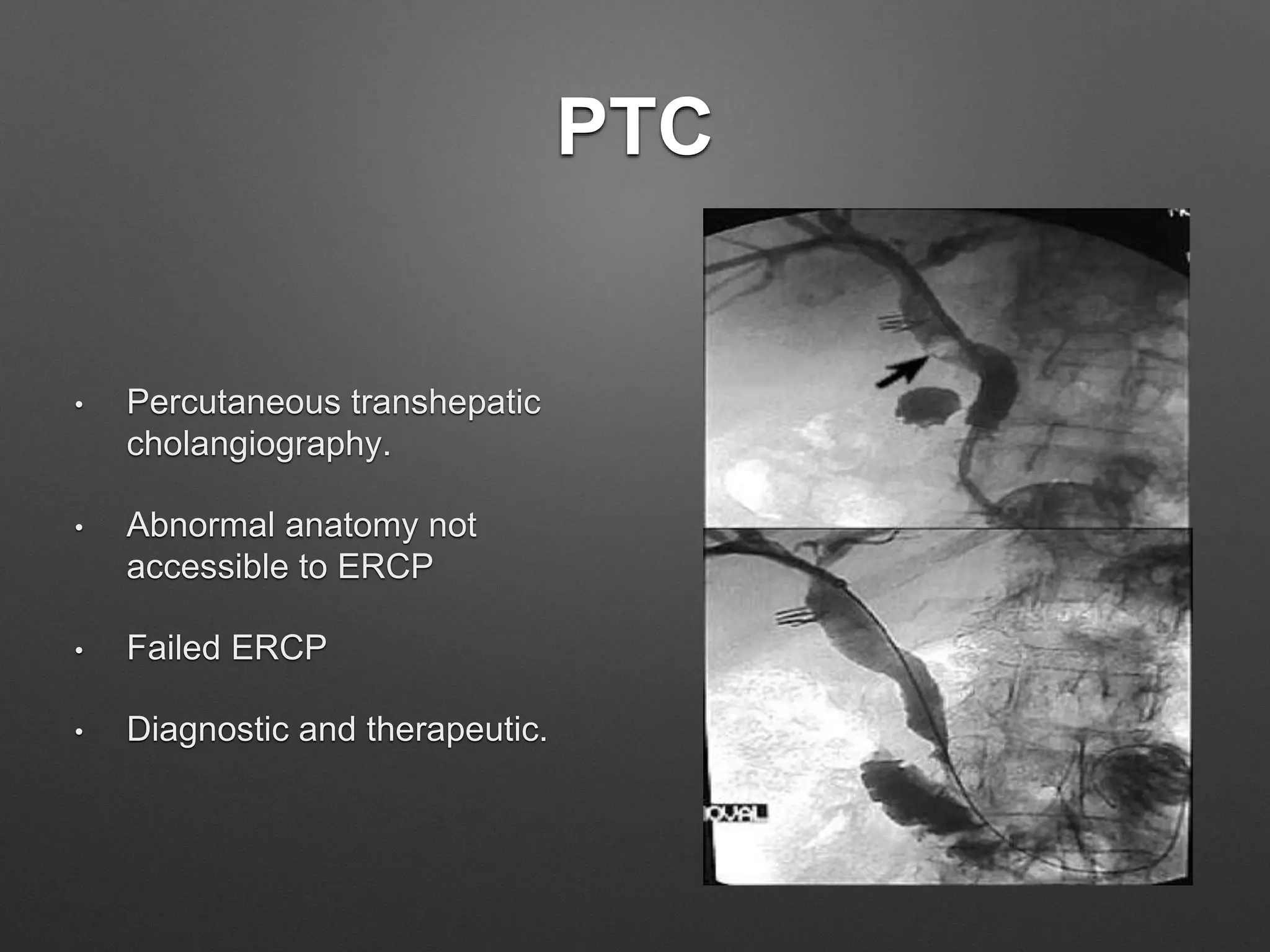 PTC
• Percutaneous transhepatic
cholangiography.
• Abnormal anatomy not
accessible to ERCP
• Failed ERCP
• Diagnostic and therapeutic.
 