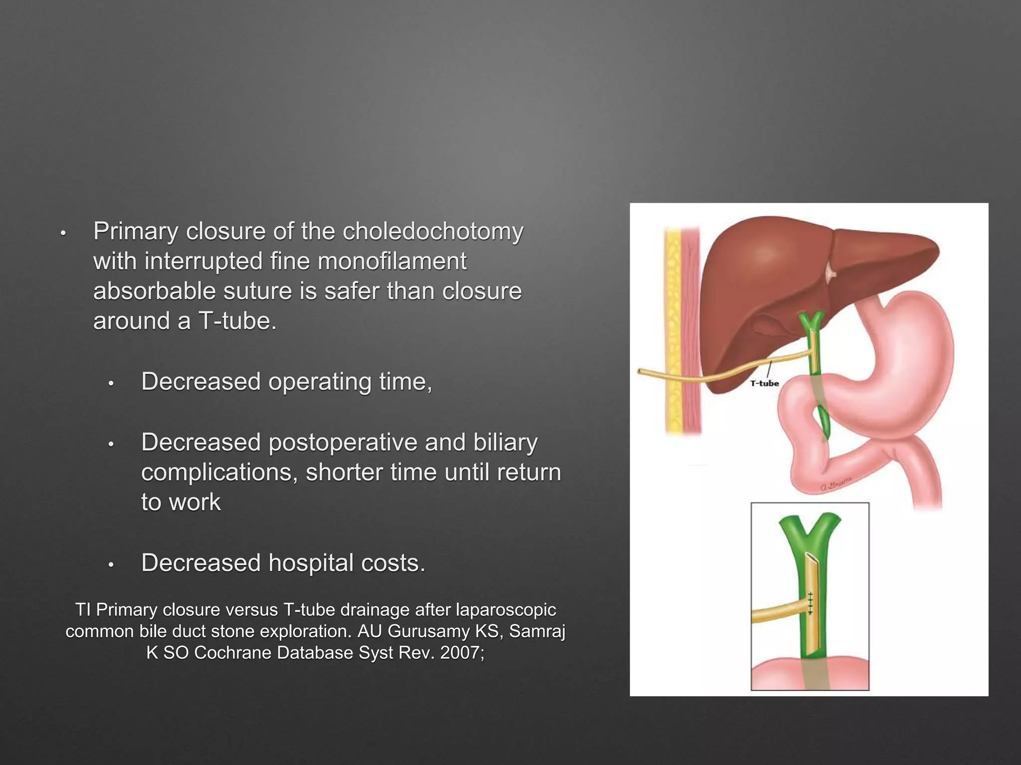 • Primary closure of the choledochotomy
with interrupted fine monofilament
absorbable suture is safer than closure
around a T-tube.
• Decreased operating time,
• Decreased postoperative and biliary
complications, shorter time until return
to work
• Decreased hospital costs.
TI Primary closure versus T-tube drainage after laparoscopic
common bile duct stone exploration. AU Gurusamy KS, Samraj
K SO Cochrane Database Syst Rev. 2007;
 