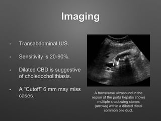 Imaging
• Transabdominal U/S.
• Sensitivity is 20-90%.
• Dilated CBD is suggestive
of choledocholithiasis.
• A “Cutoff” 6 mm may miss
cases.
A transverse ultrasound in the
region of the porta hepatis shows
multiple shadowing stones
(arrows) within a dilated distal
common bile duct.
 