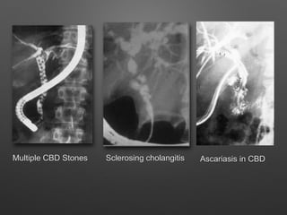 Sclerosing cholangitisMultiple CBD Stones Ascariasis in CBD
 