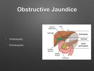 Obstructive Jaundice
• Intrahepatic.
• Extrahepatic.
 