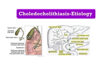 Choledocholithiasis-Etiology
 