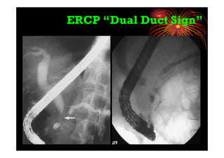ERCP “Dual Duct Sign”
 
