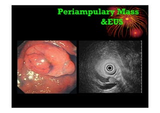 Periampulary Mass
&EUS
 