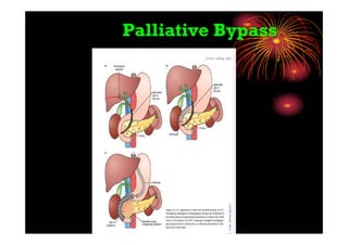 Palliative Bypass
 