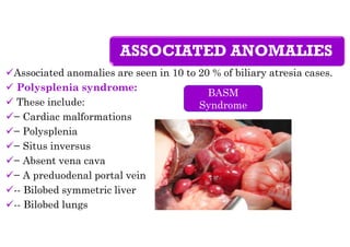 ASSOCIATED ANOMALIES
Associated anomalies are seen in 10 to 20 % of biliary atresia cases.
 Polysplenia syndrome:
 These include:
− Cardiac malformations
− Polysplenia
− Situs inversus
− Absent vena cava
− A preduodenal portal vein
-- Bilobed symmetric liver
-- Bilobed lungs
BASM
Syndrome
 
