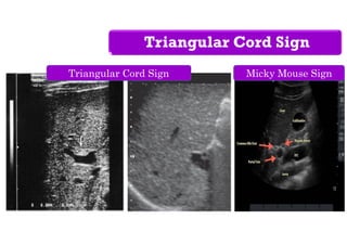 Triangular Cord Sign
Triangular Cord Sign Micky Mouse Sign
 