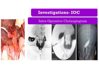 Investigations- IOC
Intra Operative Cholangiogram
 