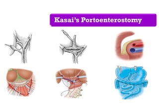 Kasai’s Portoenterostomy
 