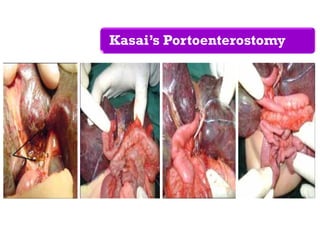 Kasai’s Portoenterostomy
 
