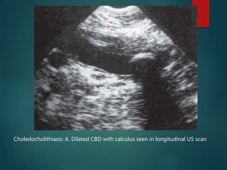 Imaging of Obstructive jaundice | PPTX