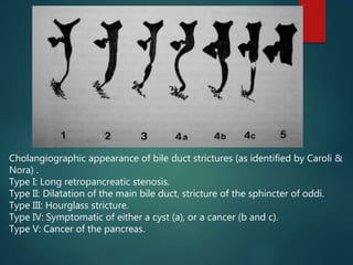Caroli Types Imaging of Obstructive jaundice | PPTX