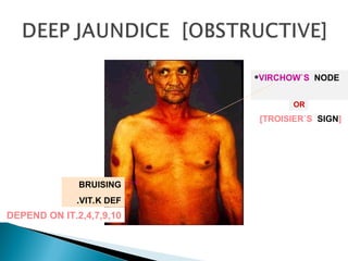 Toisier Sign obstructivejaundice-obstructive jaundice in neonate | PPT