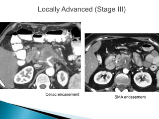 Locally Advanced (Stage III)
Celiac encasement
SMA encasement
 