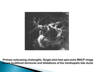 Primary sclerosing cholangitis. Single-shot fast spin-echo MRCP image
shows multifocal strictures and dilatations of the intrahepatic bile ducts
 