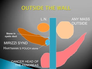 L.N.
CANCER HEAD OF
THE PANCREAS
MIRIZZI SYND
ANY MASS
OUTSIDE
HARTMANN`S POUCH stone
Stone in
cystic duct
 