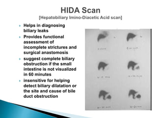  Helps in diagnosing
biliary leaks
 Provides functional
assessment of
incomplete strictures and
surgical anastomosis
 suggest complete biliary
obstruction if the small
intestine is not visualized
in 60 minutes
 insensitive for helping
detect biliary dilatation or
the site and cause of bile
duct obstruction
 