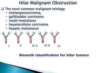 Hilar Malignant Obstruction
 The most common malignant etiology
• cholangiocarcinoma,
• gallbladder carcinoma
• nodal metastases
• hepatocellular carcinoma
• hepatic metastases
Bismuth classification for hilar tumors
I II III A III B IV
 