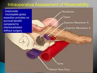 Intraoperative Assessment of Resectability
• Inaccurate
• Incomplete gross
resection provides no
survival benefit
compared to
chemoradiation
without surgery
 