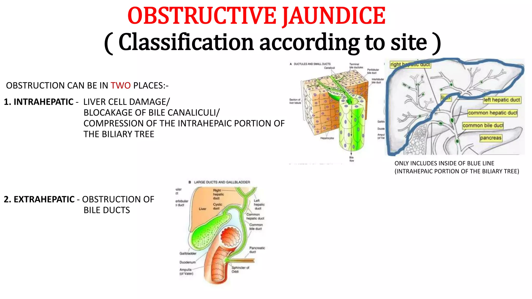 OBSTRUCTIVE JAUNDICE
( Classification according to site )
OBSTRUCTION CAN BE IN TWO PLACES:-
1. INTRAHEPATIC - LIVER CELL DAMAGE/
BLOCAKAGE OF BILE CANALICULI/
COMPRESSION OF THE INTRAHEPAIC PORTION OF
THE BILIARY TREE
2. EXTRAHEPATIC - OBSTRUCTION OF
BILE DUCTS
ONLY INCLUDES INSIDE OF BLUE LINE
(INTRAHEPAIC PORTION OF THE BILIARY TREE)
 