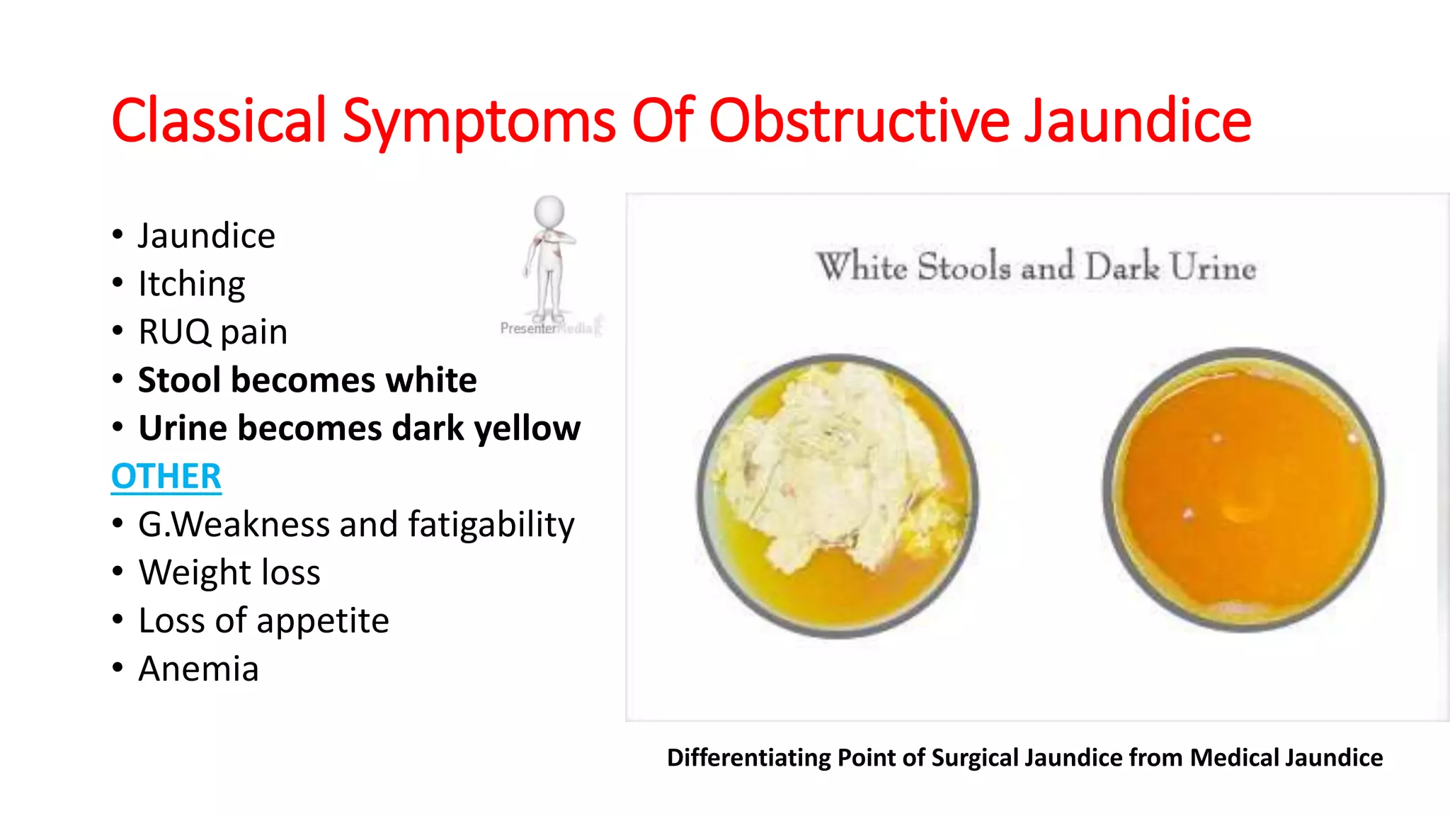 Classical Symptoms Of Obstructive Jaundice
• Jaundice
• Itching
• RUQ pain
• Stool becomes white
• Urine becomes dark yellow
OTHER
• G.Weakness and fatigability
• Weight loss
• Loss of appetite
• Anemia
Differentiating Point of Surgical Jaundice from Medical Jaundice
 