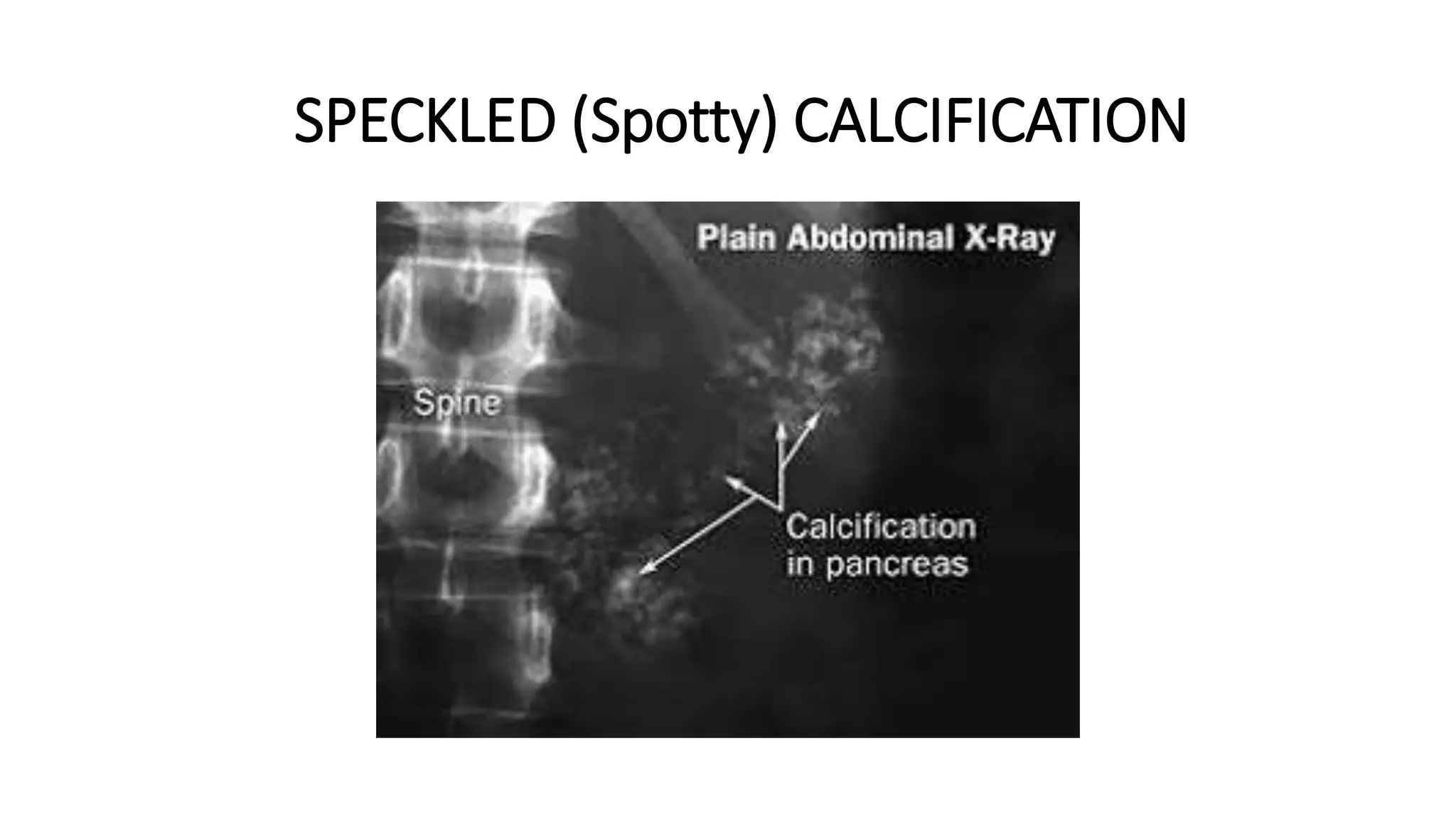 SPECKLED (Spotty) CALCIFICATION
 
