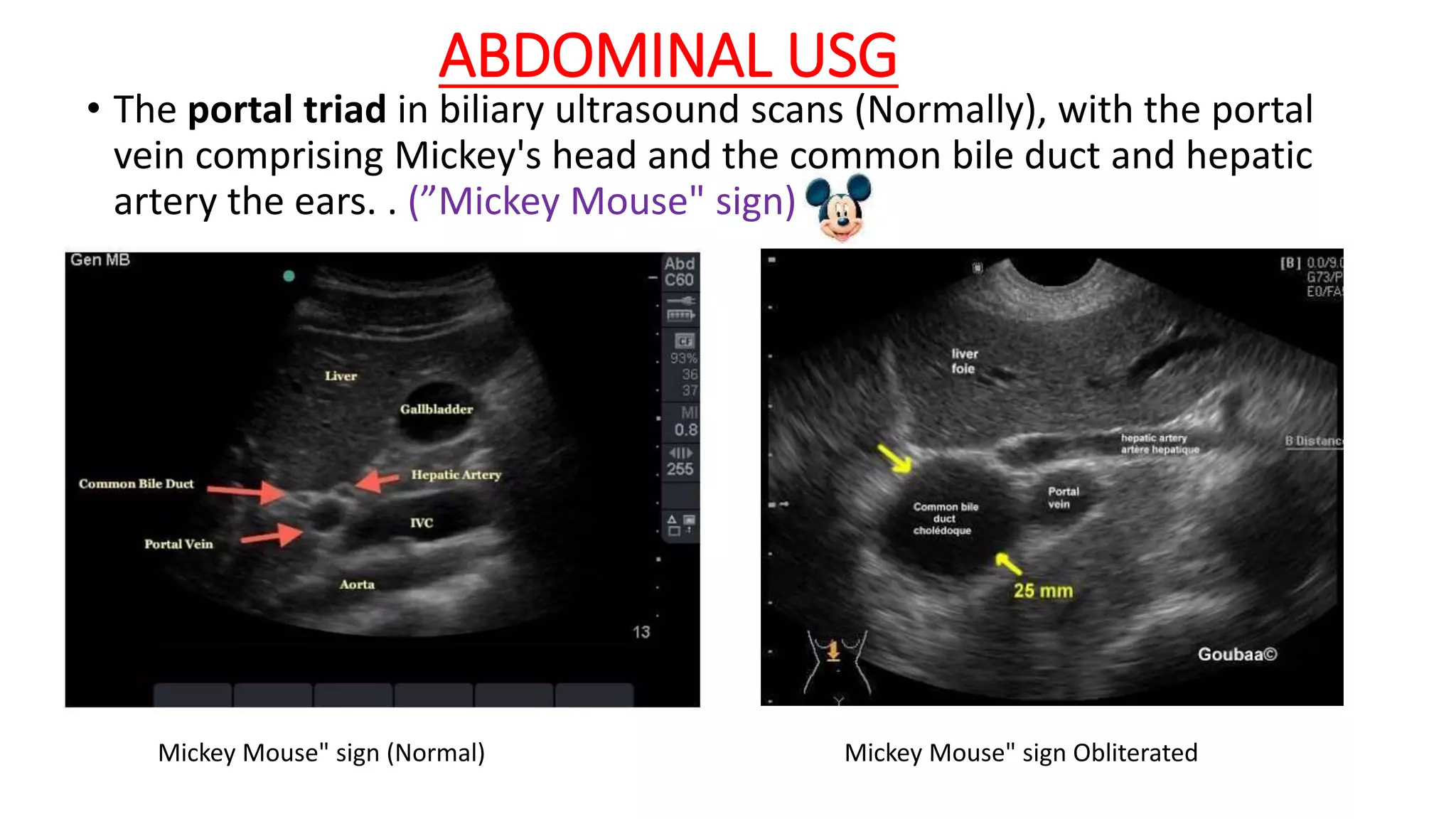 ABDOMINAL USG
• The portal triad in biliary ultrasound scans (Normally), with the portal
vein comprising Mickey's head and the common bile duct and hepatic
artery the ears. . (”Mickey Mouse" sign)
Mickey Mouse" sign (Normal) Mickey Mouse" sign Obliterated
 