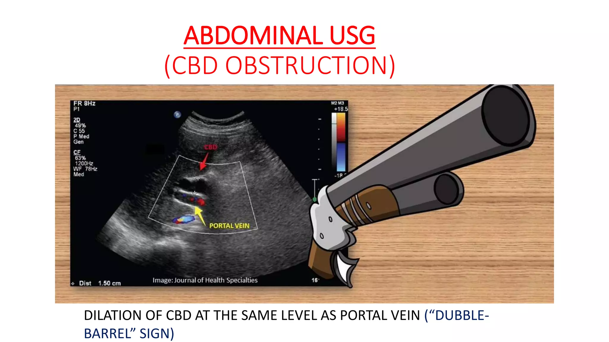 ABDOMINAL USG
(CBD OBSTRUCTION)
DILATION OF CBD AT THE SAME LEVEL AS PORTAL VEIN (“DUBBLE-
BARREL” SIGN)
 