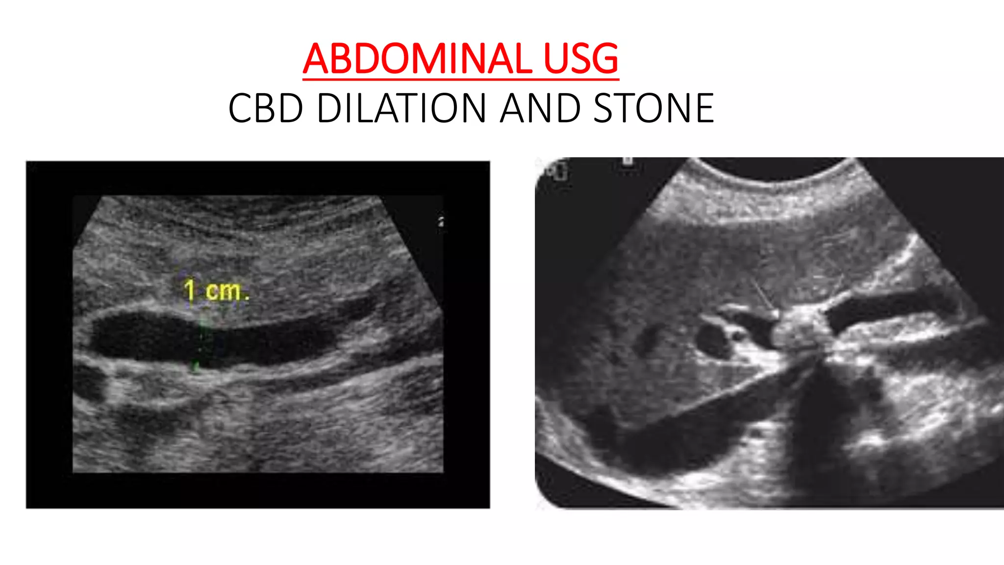 ABDOMINAL USG
CBD DILATION AND STONE
 