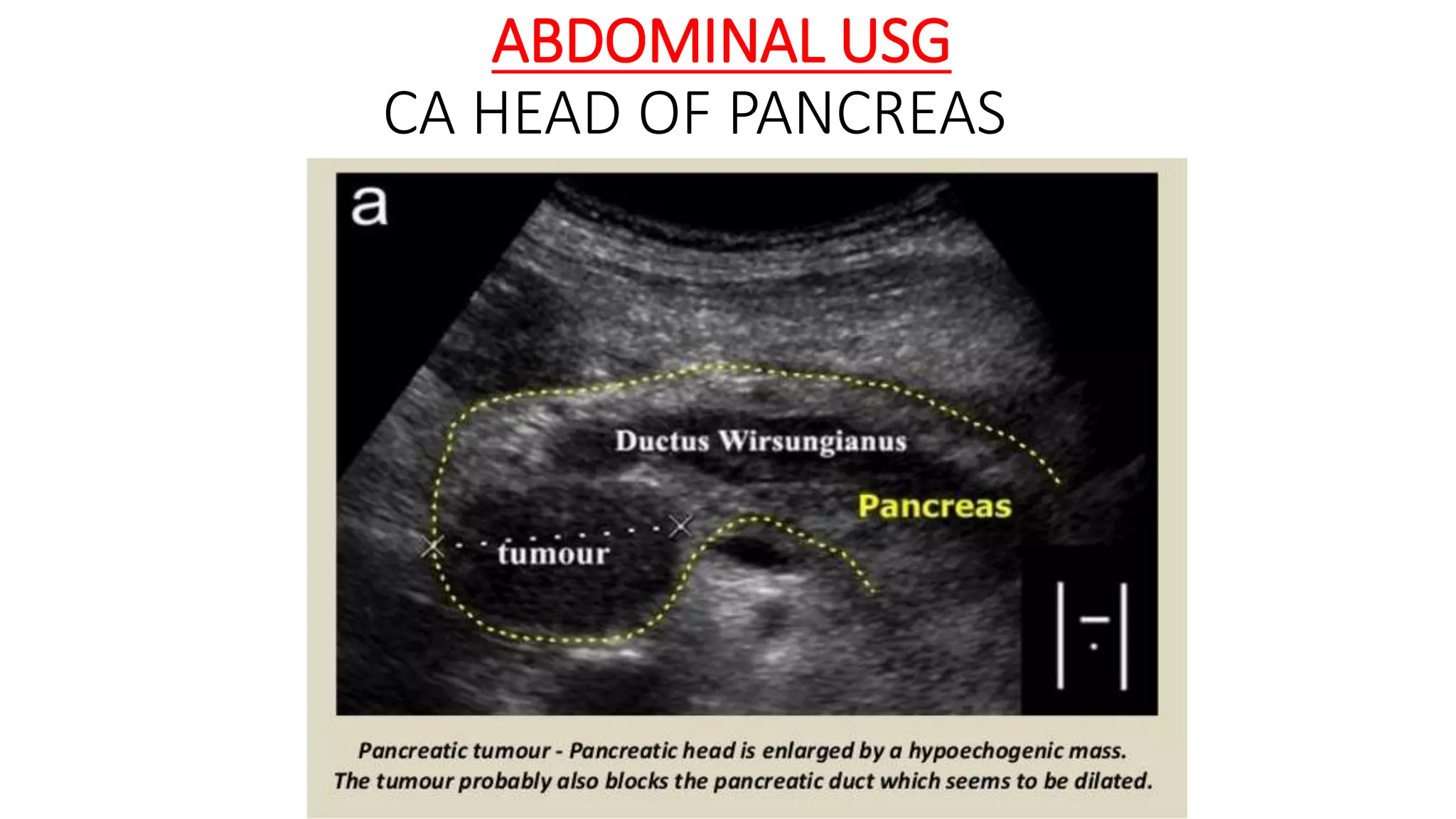 ABDOMINAL USG
CA HEAD OF PANCREAS
 