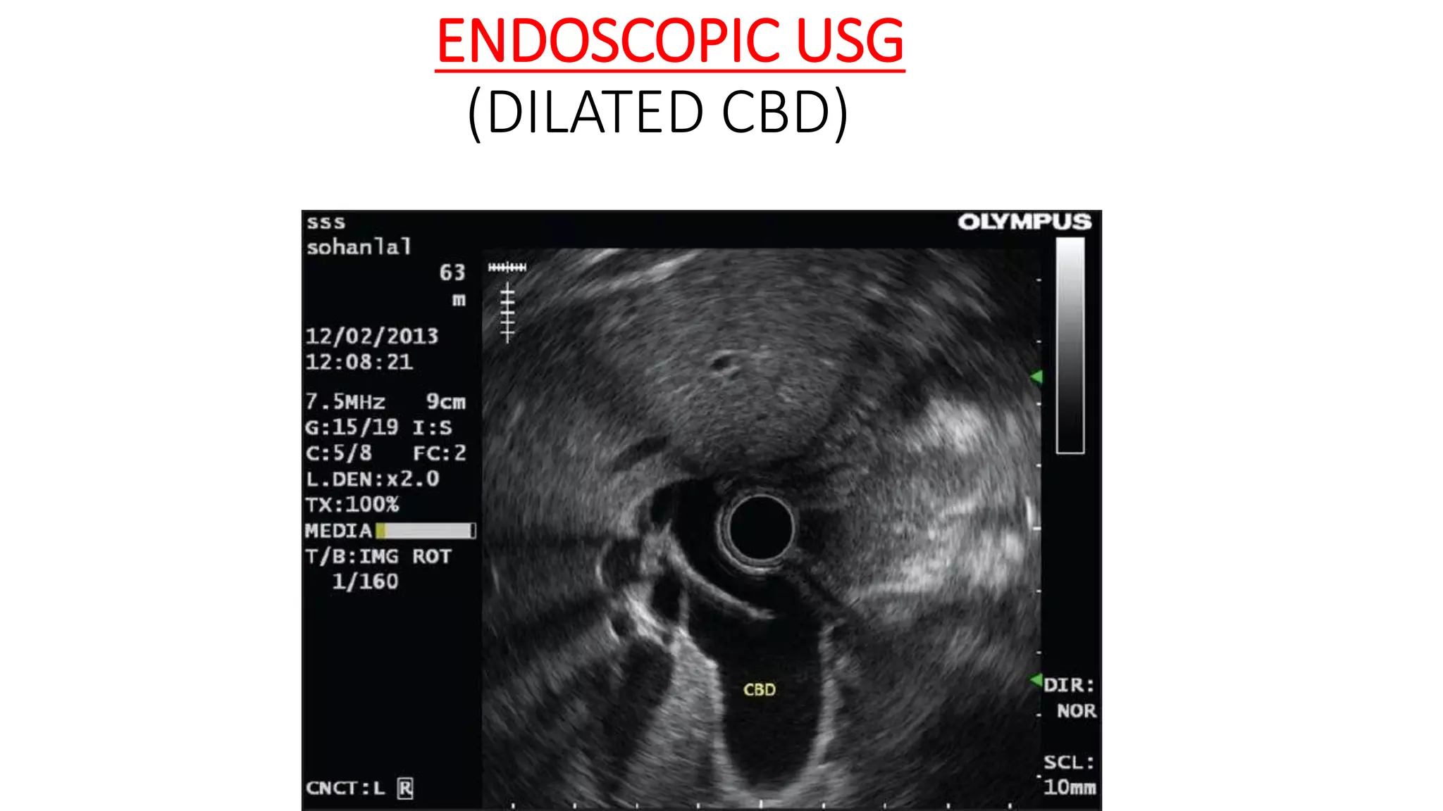 ENDOSCOPIC USG
(DILATED CBD)
 