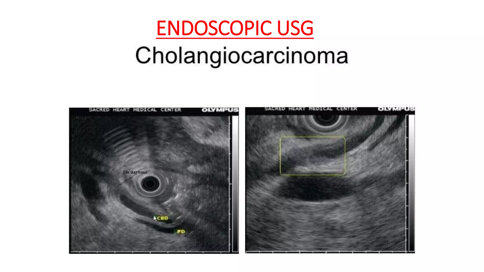 ENDOSCOPIC USG
 