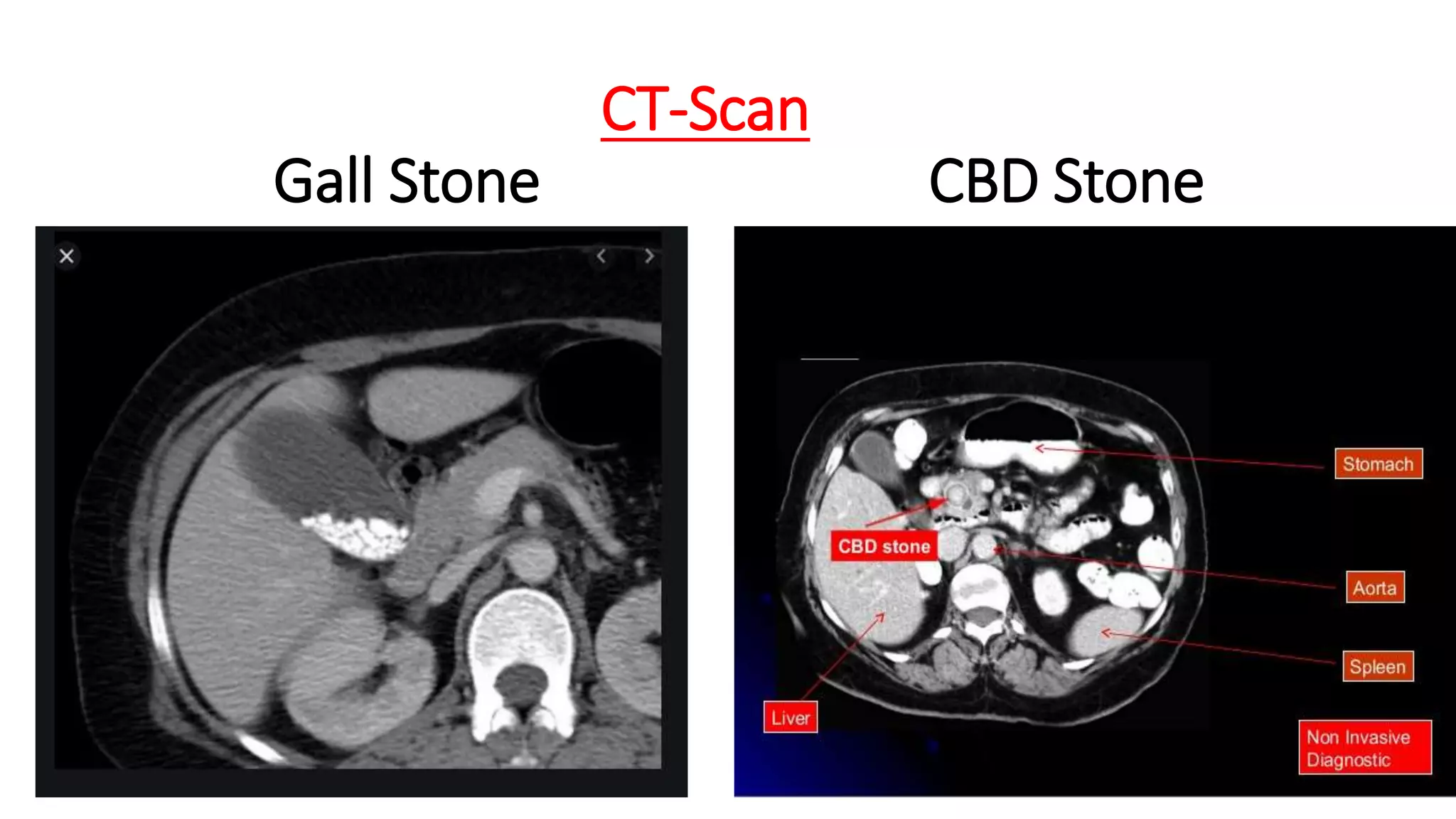CT-Scan
Gall Stone CBD Stone
 