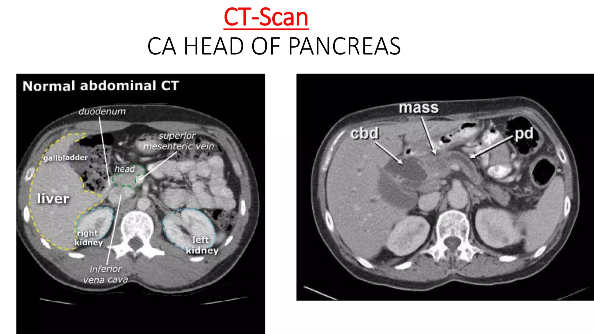 CT-Scan
CA HEAD OF PANCREAS
 