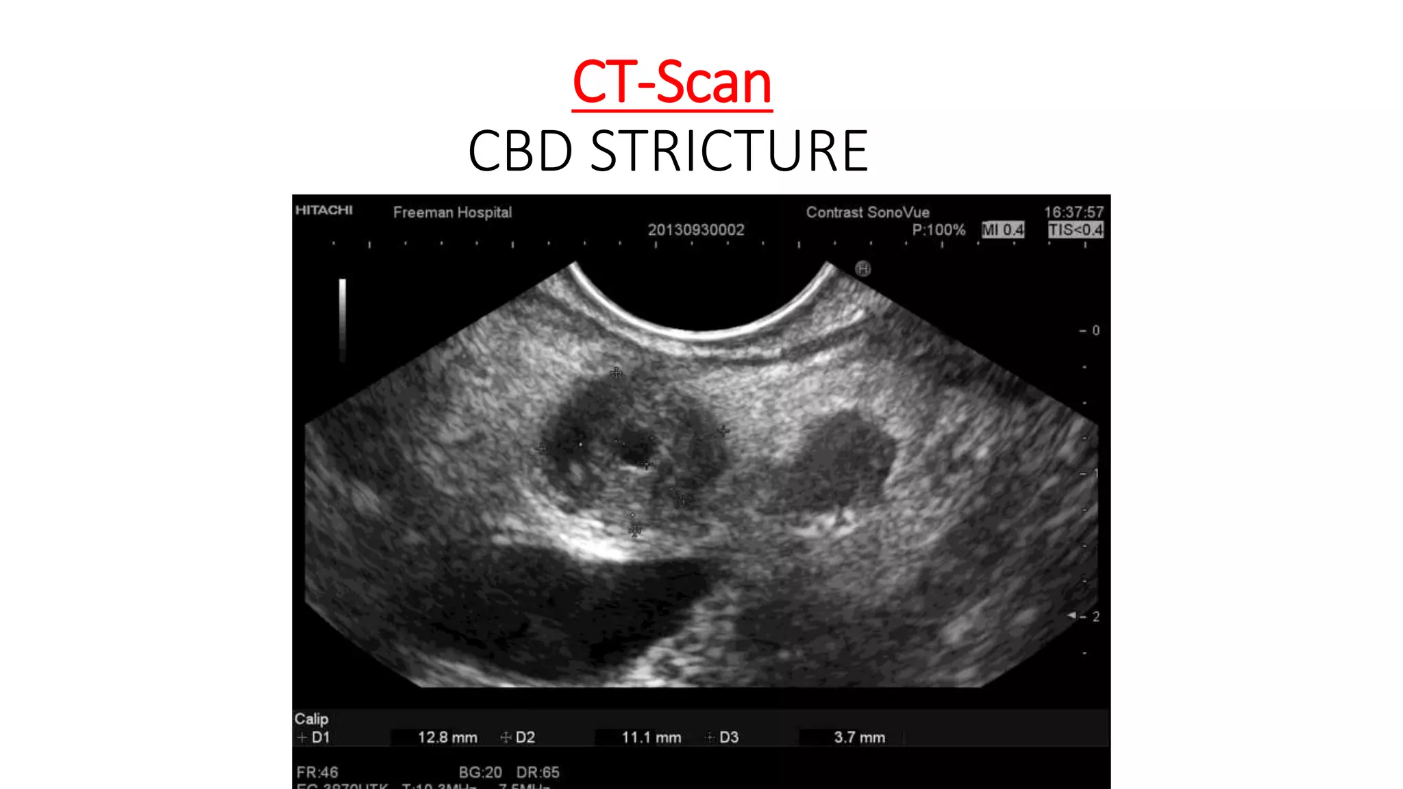 CT-Scan
CBD STRICTURE
 