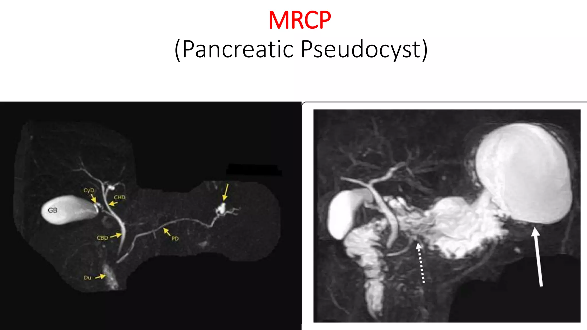 MRCP
(Pancreatic Pseudocyst)
 