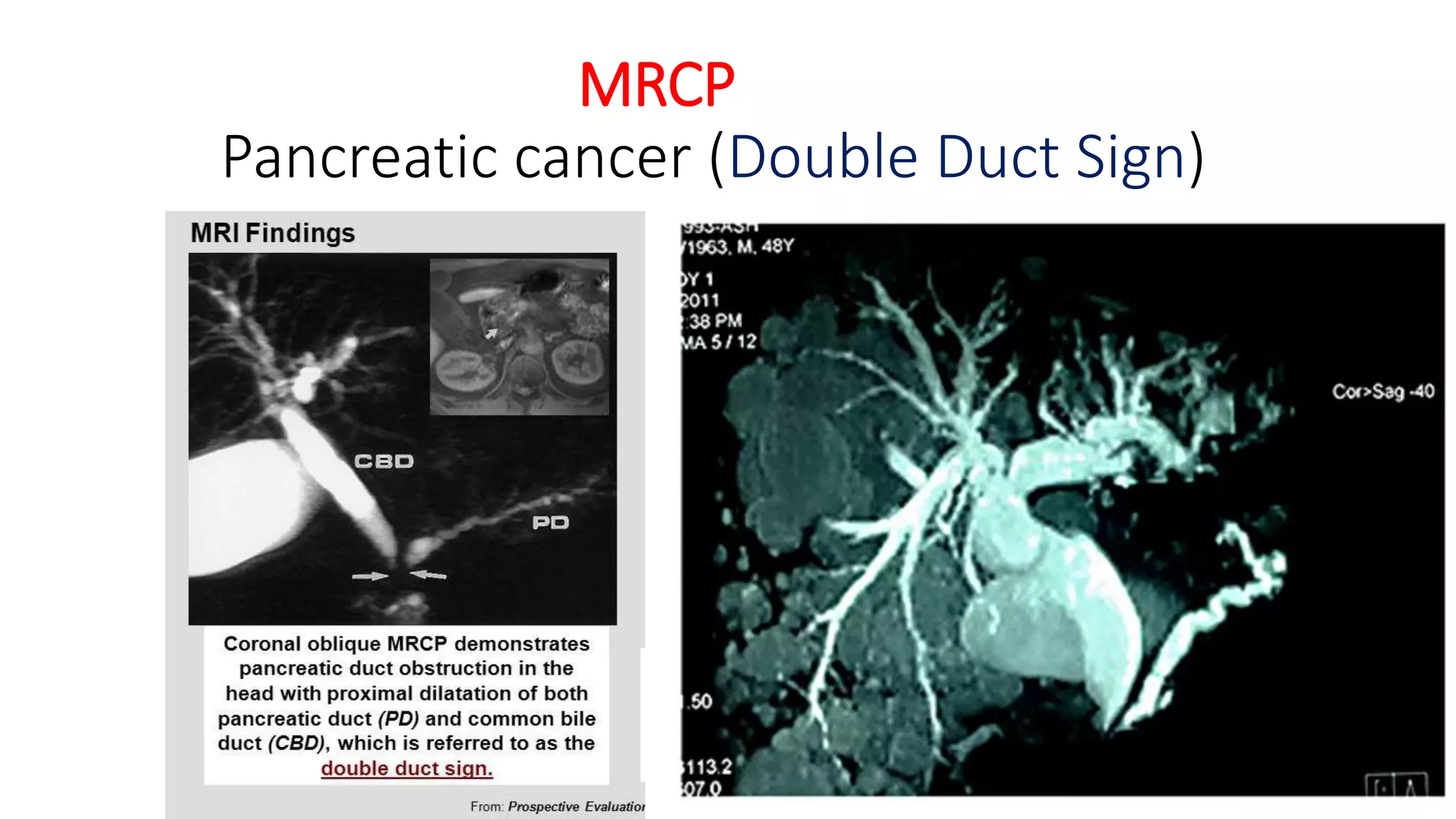 MRCP
Pancreatic cancer (Double Duct Sign)
 