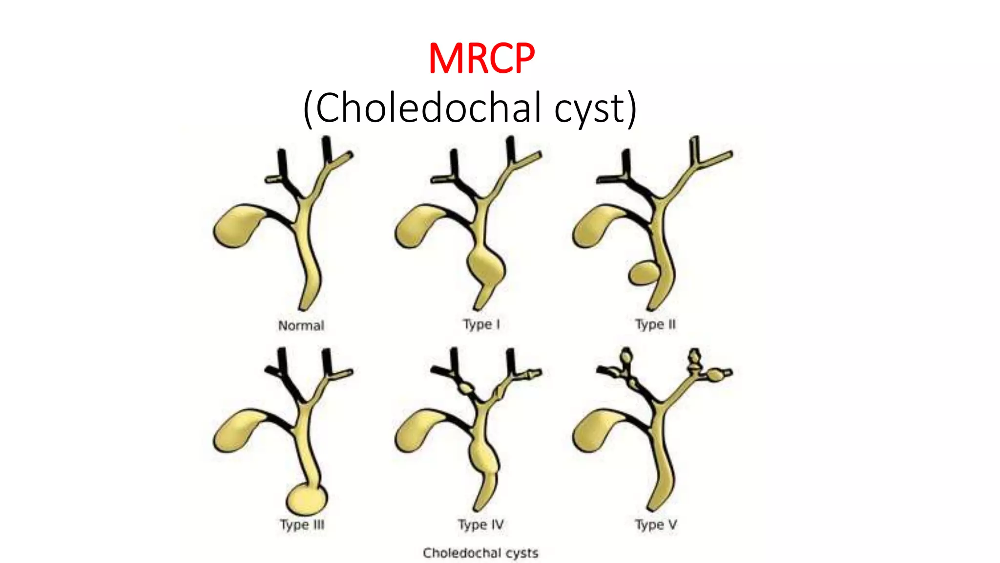 MRCP
(Choledochal cyst)
 