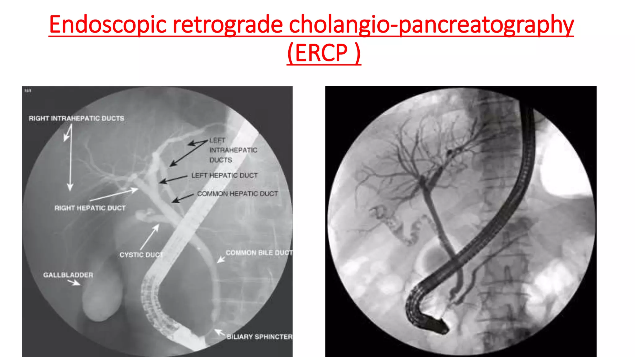 Endoscopic retrograde cholangio-pancreatography
(ERCP )
 