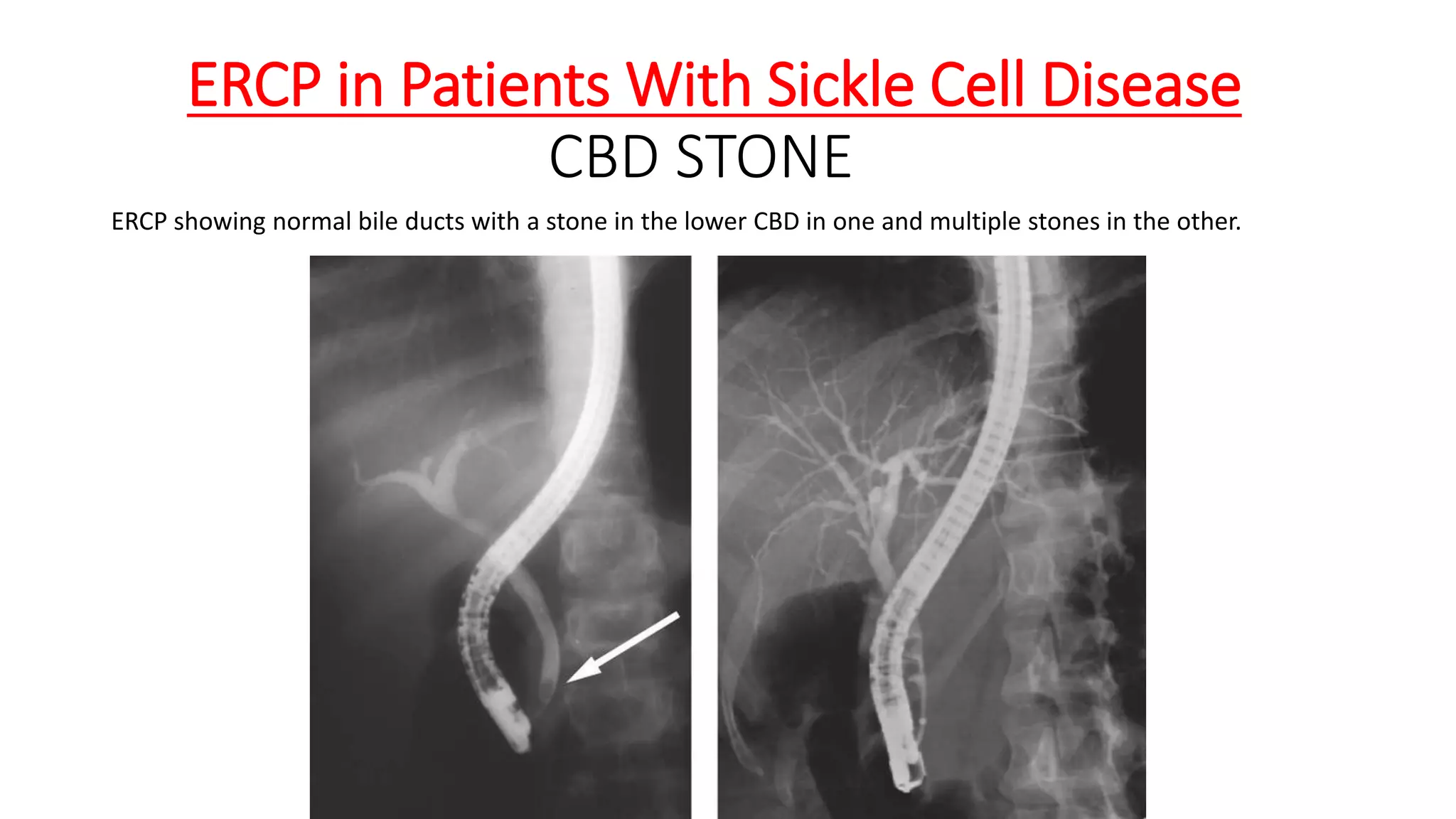 ERCP in Patients With Sickle Cell Disease
CBD STONE
ERCP showing normal bile ducts with a stone in the lower CBD in one and multiple stones in the other.
 