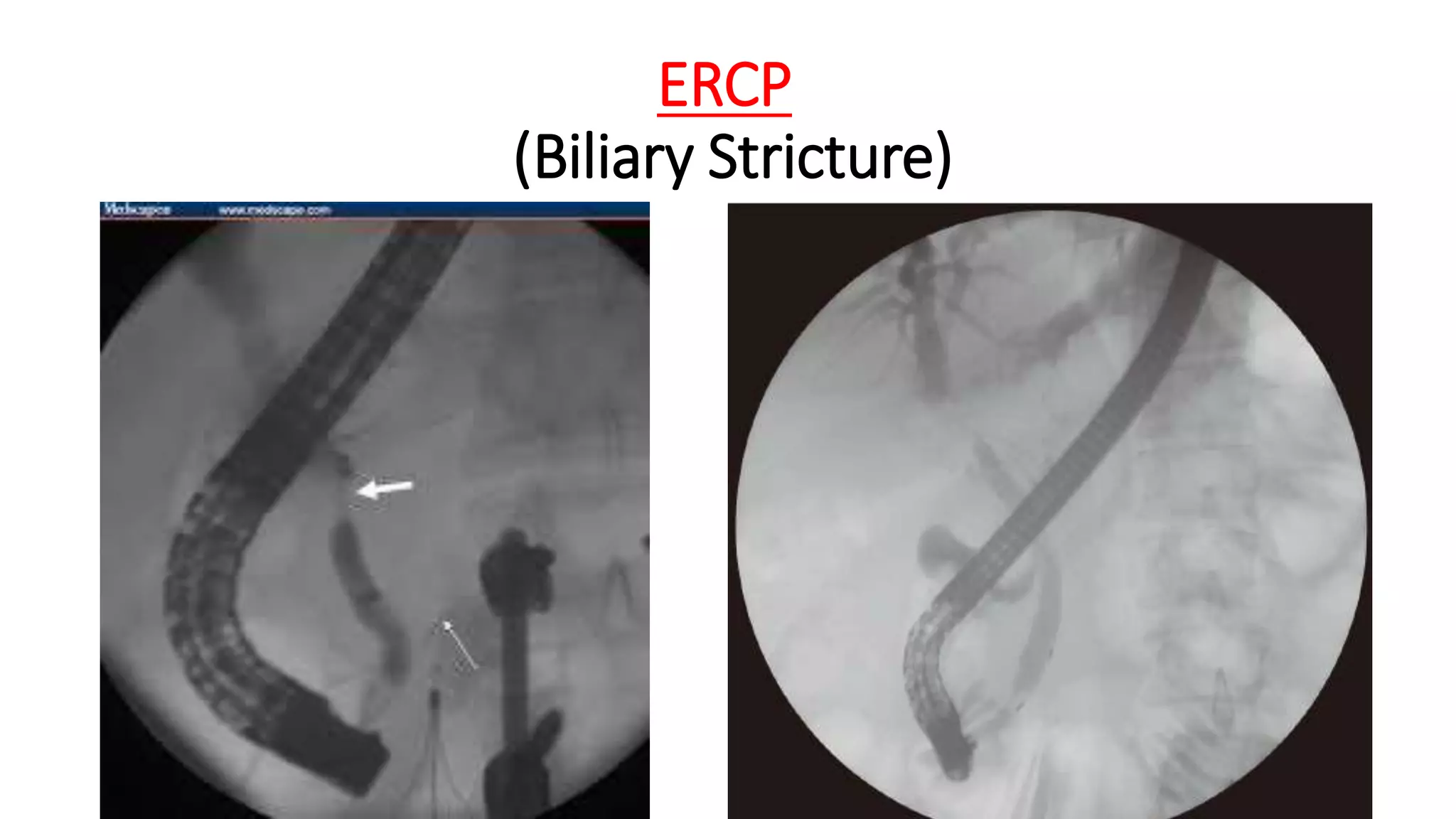 ERCP
(Biliary Stricture)
 
