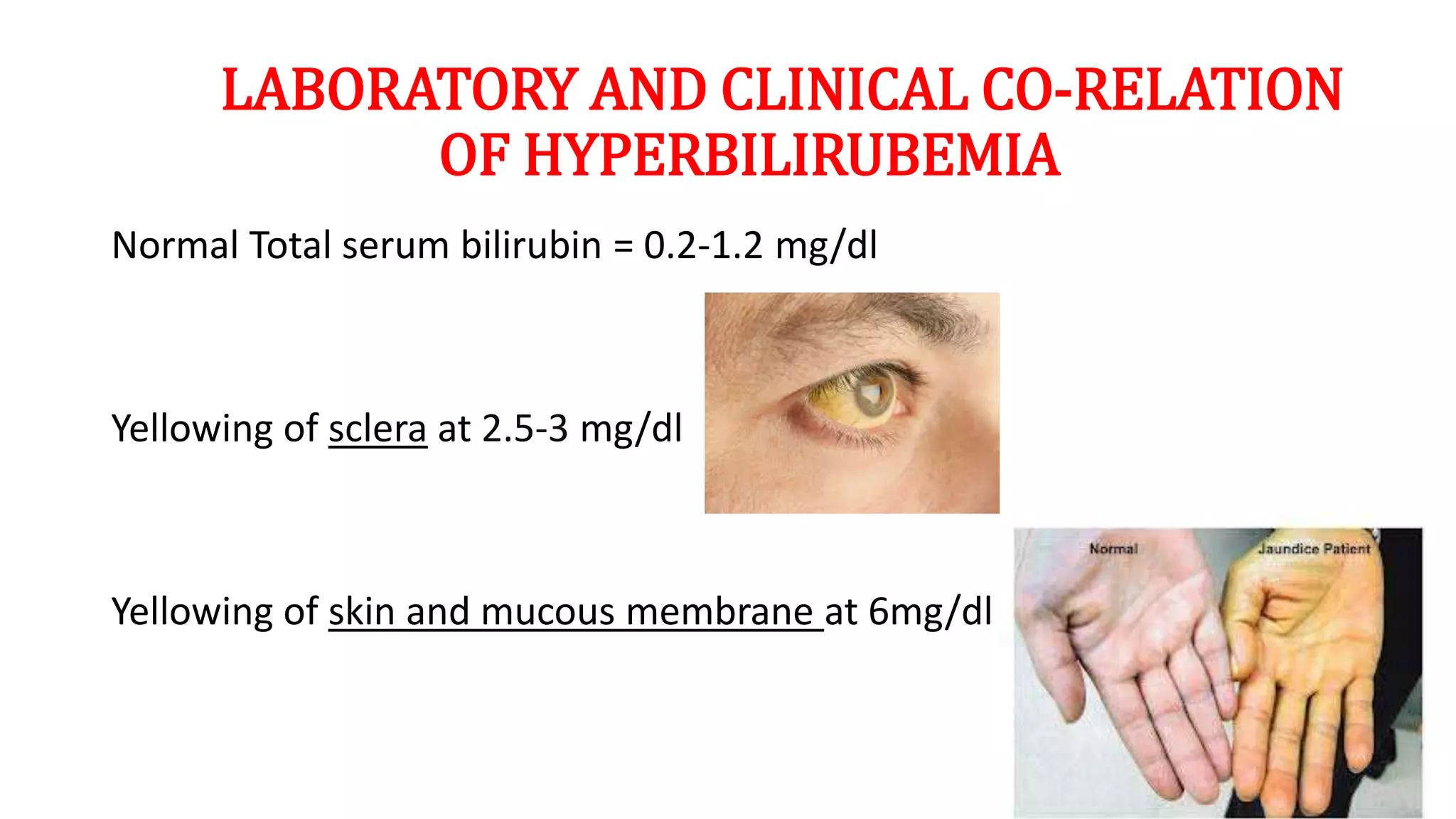 LABORATORY AND CLINICAL CO-RELATION
OF HYPERBILIRUBEMIA
Normal Total serum bilirubin = 0.2-1.2 mg/dl
Yellowing of sclera at 2.5-3 mg/dl
Yellowing of skin and mucous membrane at 6mg/dl
 