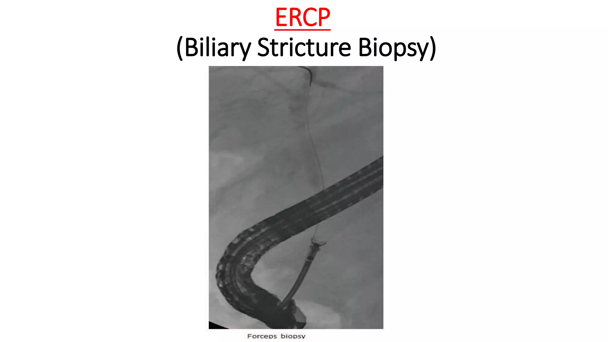 ERCP
(Biliary Stricture Biopsy)
 
