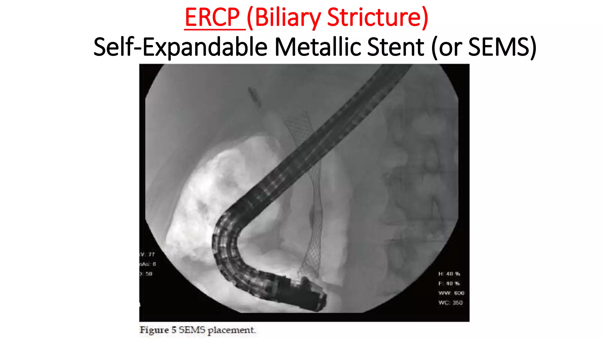ERCP (Biliary Stricture)
Self-Expandable Metallic Stent (or SEMS)
 