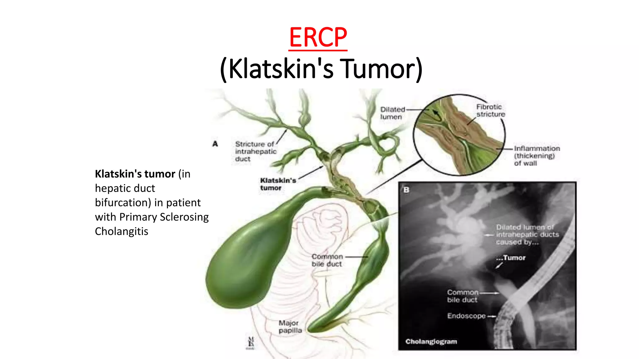 ERCP
(Klatskin's Tumor)
Klatskin's tumor (in
hepatic duct
bifurcation) in patient
with Primary Sclerosing
Cholangitis
 