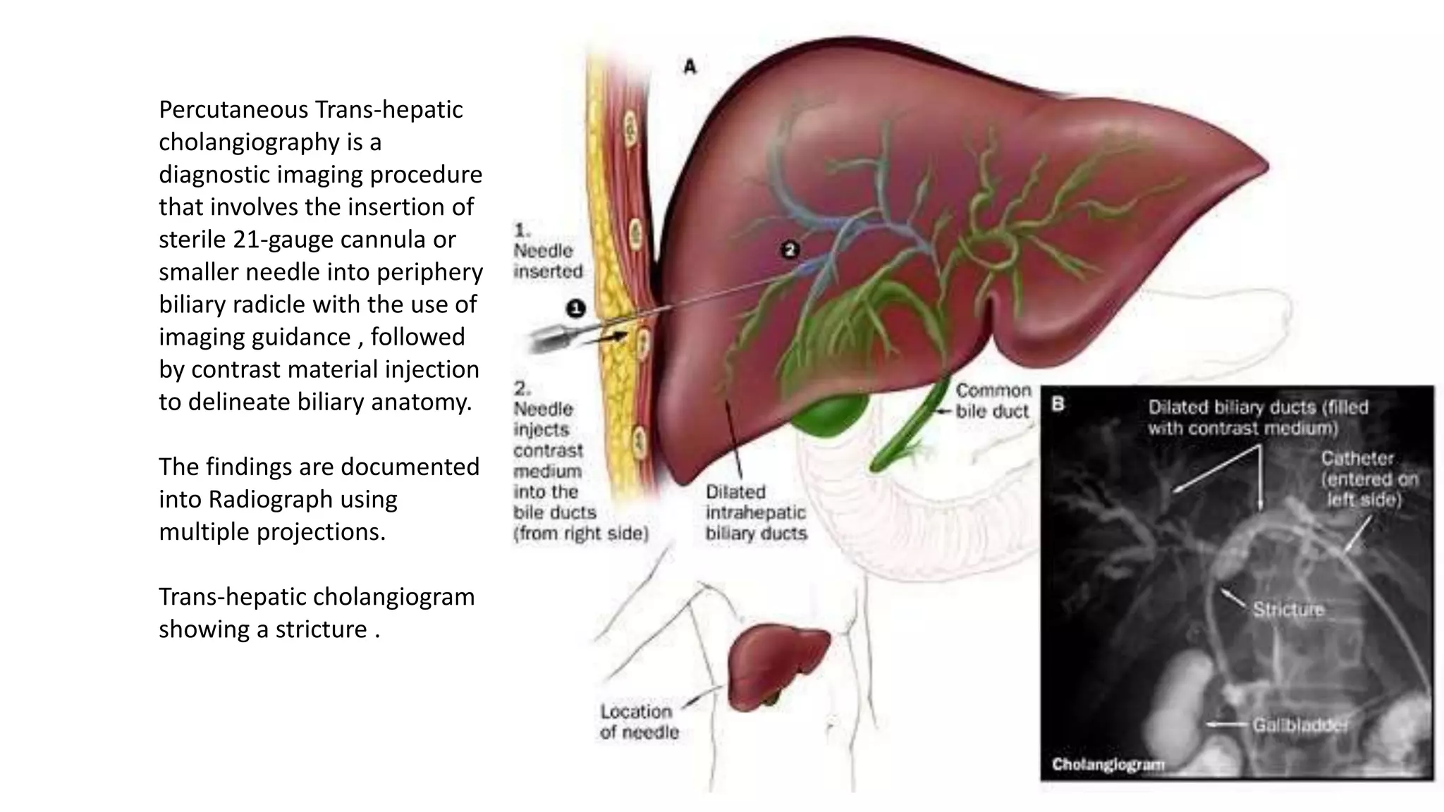 Percutaneous Trans-hepatic
cholangiography is a
diagnostic imaging procedure
that involves the insertion of
sterile 21-gauge cannula or
smaller needle into periphery
biliary radicle with the use of
imaging guidance , followed
by contrast material injection
to delineate biliary anatomy.
The findings are documented
into Radiograph using
multiple projections.
Trans-hepatic cholangiogram
showing a stricture .
 