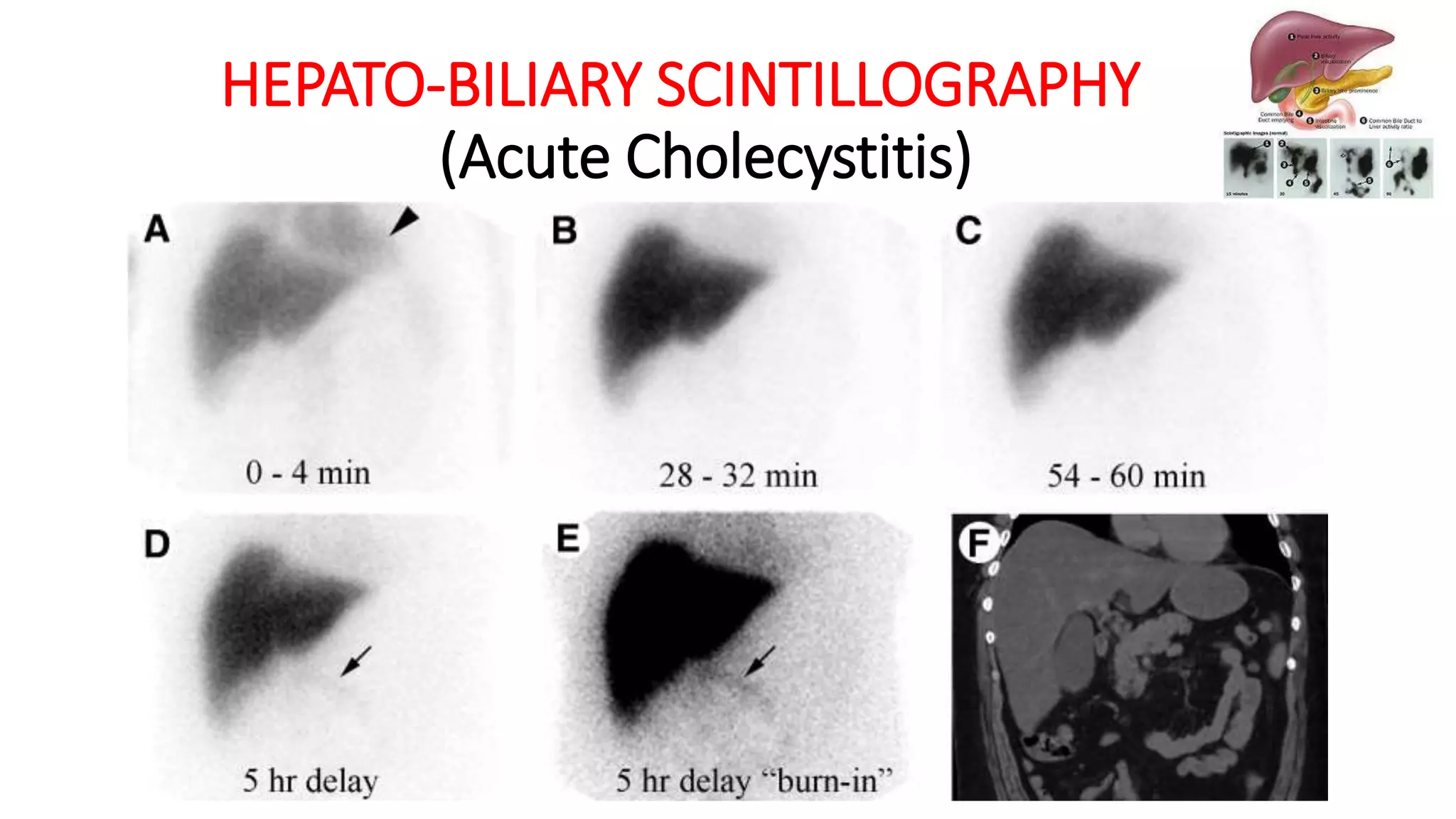 HEPATO-BILIARY SCINTILLOGRAPHY
(Acute Cholecystitis)
 