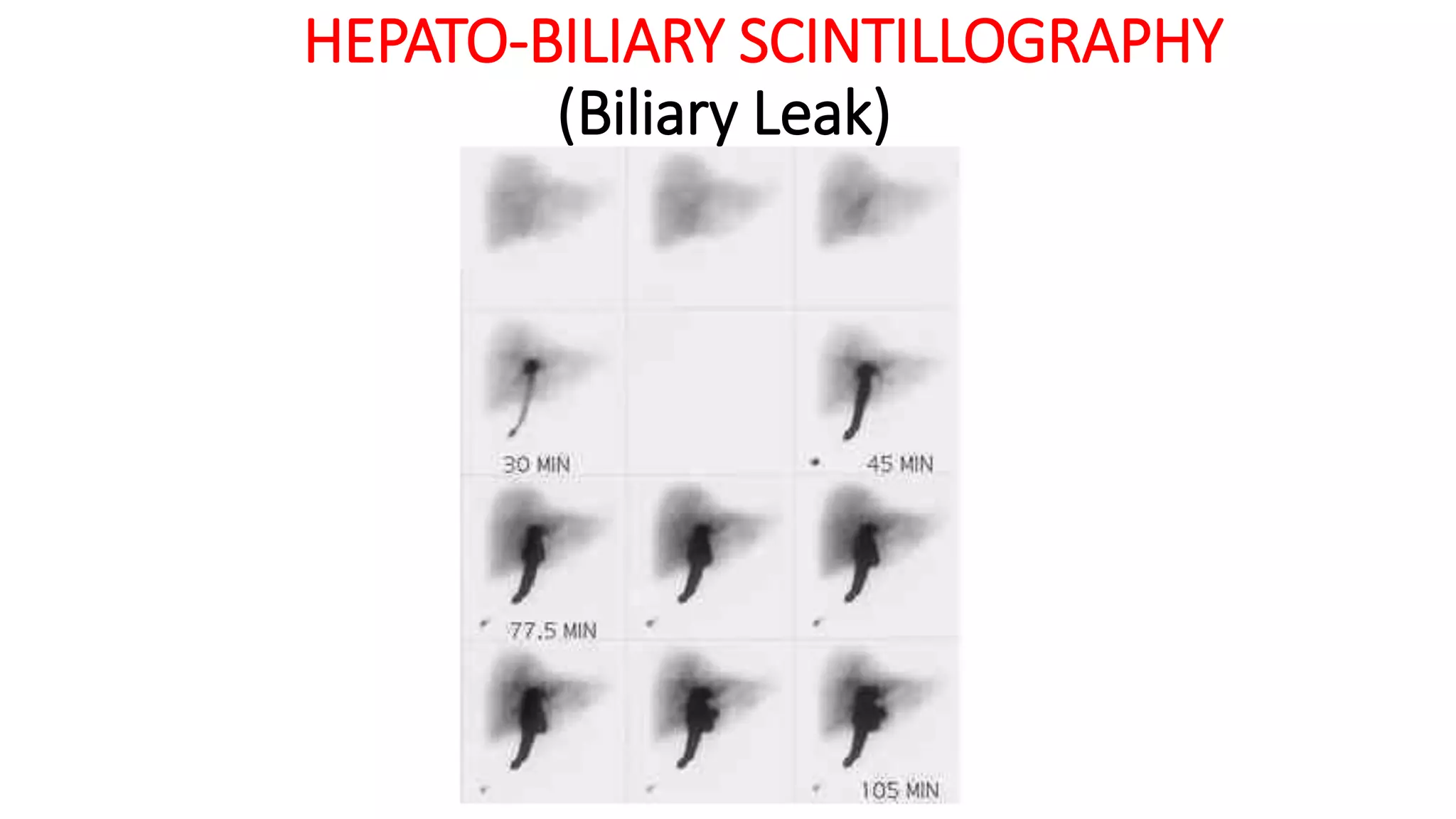 HEPATO-BILIARY SCINTILLOGRAPHY
(Biliary Leak)
 