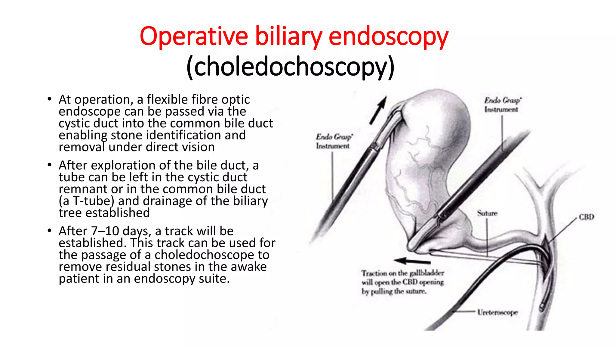 Operative biliary endoscopy
(choledochoscopy)
• At operation, a flexible fibre optic
endoscope can be passed via the
cystic duct into the common bile duct
enabling stone identification and
removal under direct vision
• After exploration of the bile duct, a
tube can be left in the cystic duct
remnant or in the common bile duct
(a T-tube) and drainage of the biliary
tree established
• After 7–10 days, a track will be
established. This track can be used for
the passage of a choledochoscope to
remove residual stones in the awake
patient in an endoscopy suite.
 
